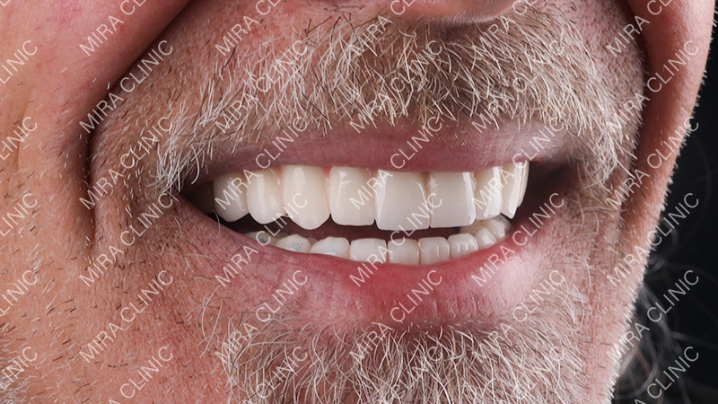 dental implant journey